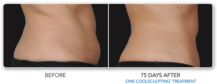 Coolsculpting Before & After Photos NJ