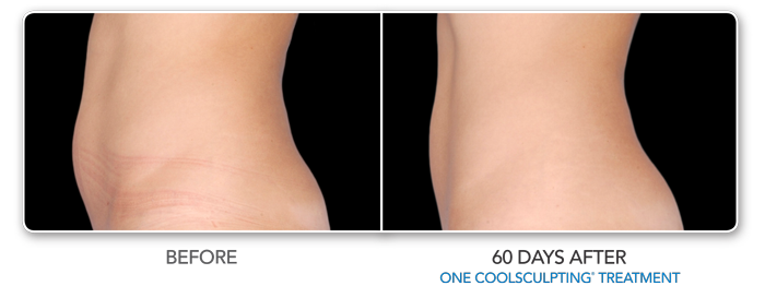 New Jersey CoolSculpting Before & After Photos