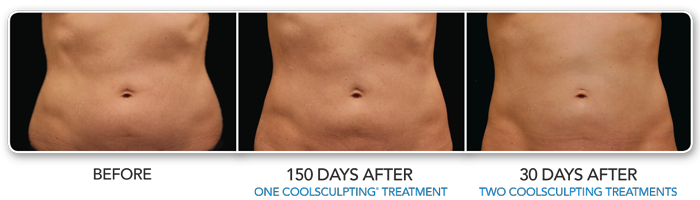 CoolSculpting Before & After Photos