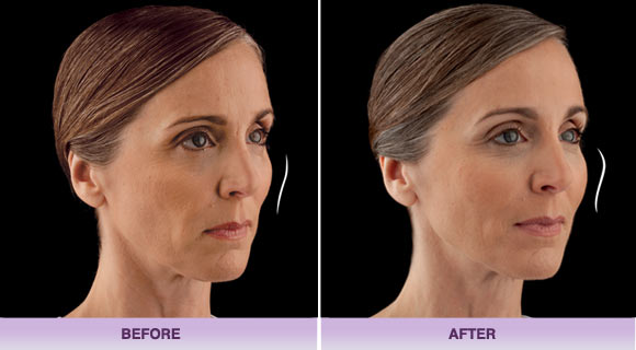 Juvederm Voluma