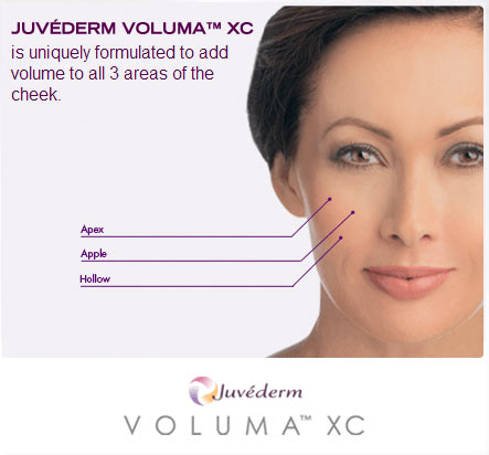 Juvederm Voluma