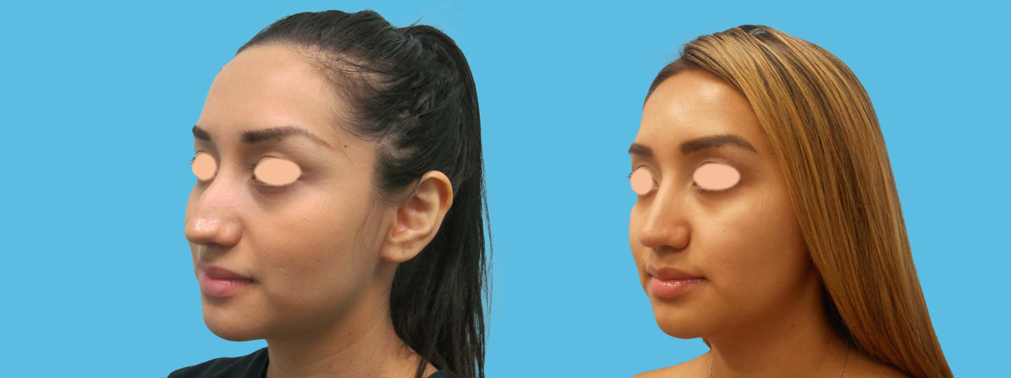 1 year rhinoplasty