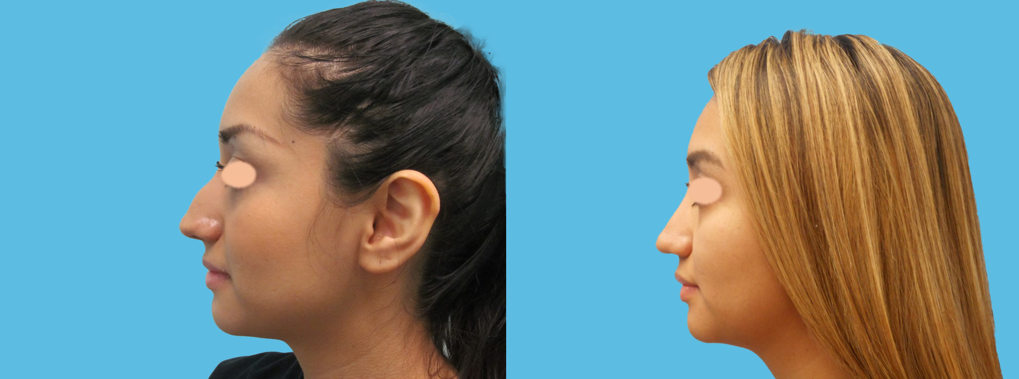 1 year rhinoplasty