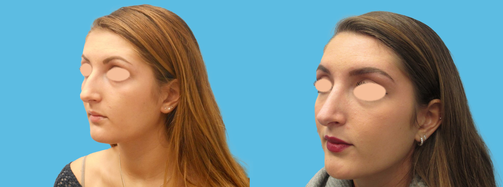 1 year rhinoplasty