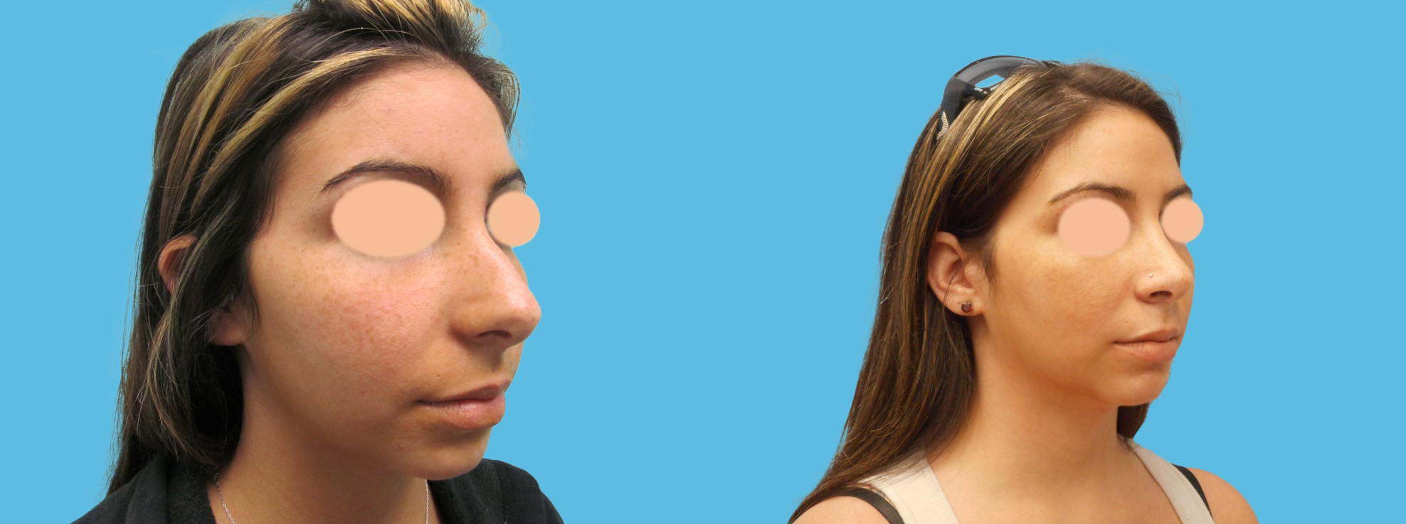 1 year rhinoplasty