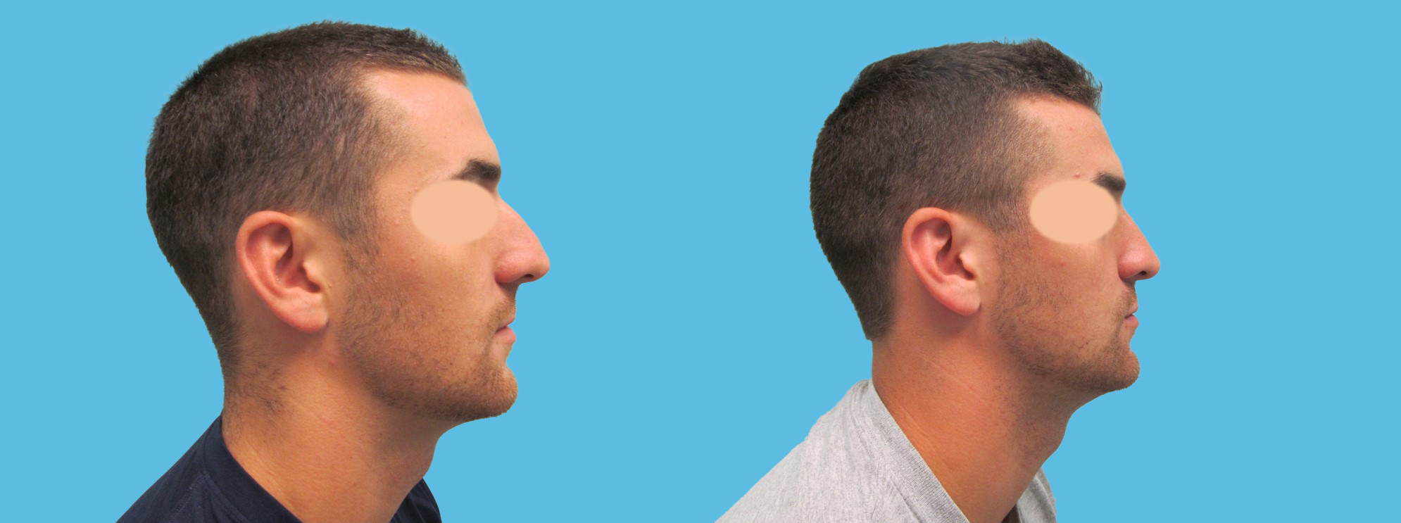 1 year rhinoplasty (preserved masculine features)