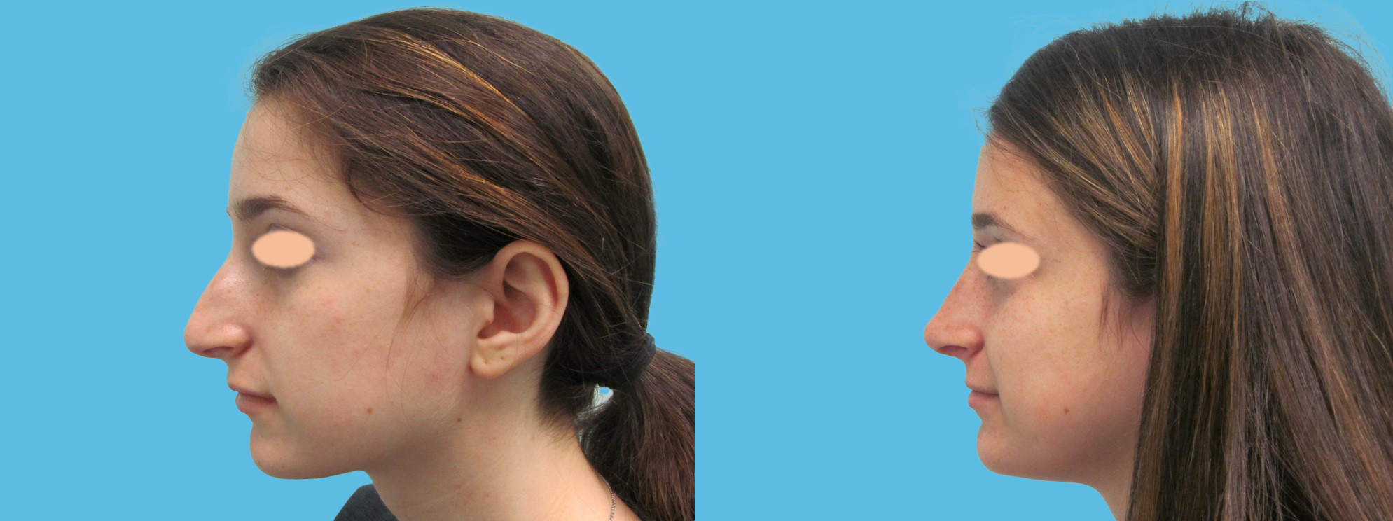 1 year rhinoplasty (convex, over-projected nose, thin skin)