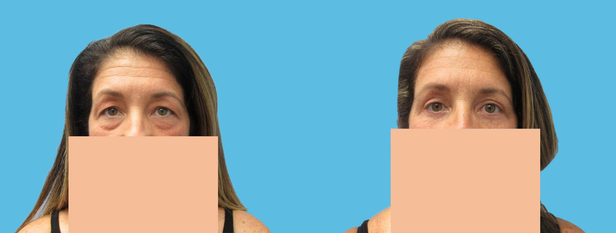 3 months upper and lower blepharoplasty