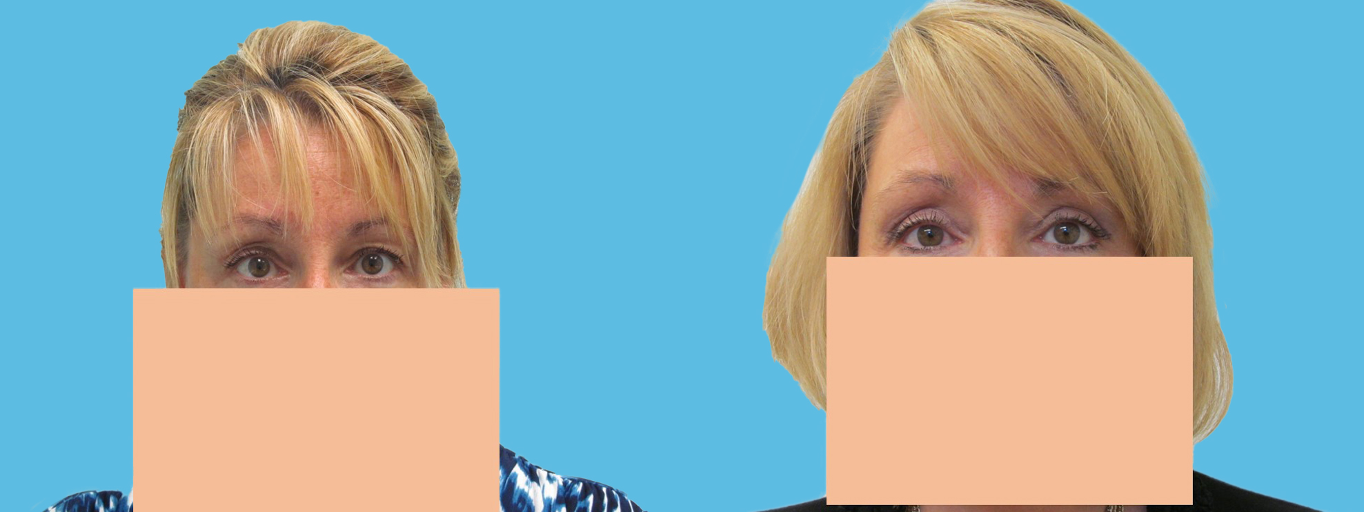 3 month upper blepharoplasty – corrective asymmetry (note: left upper eyelid)