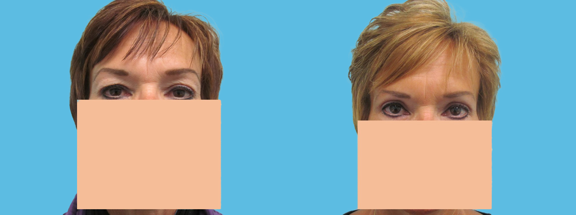 3 month upper blepharoplasty