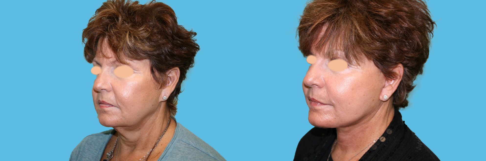 1 months facelift, necklift