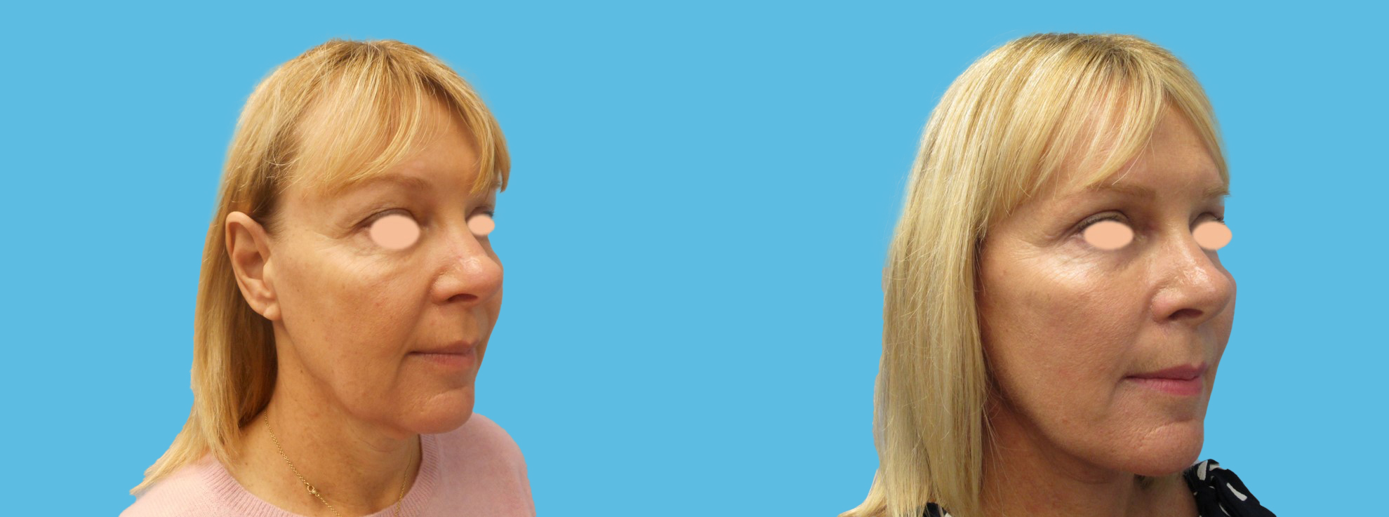 8 weeks facelift, necklift, upper blepharoplasty