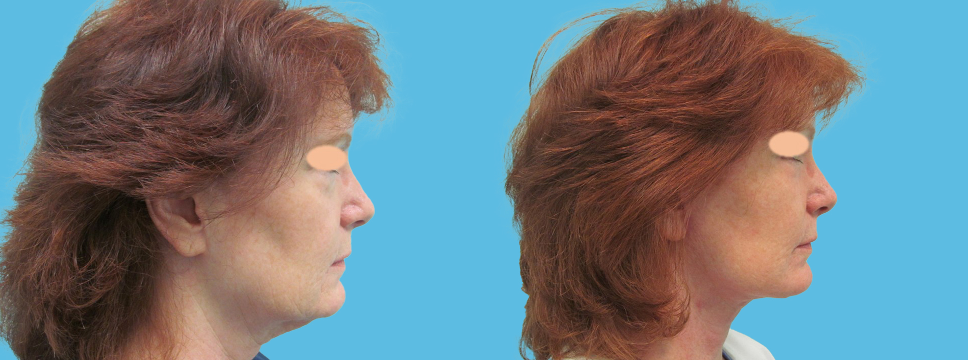 1 month facelift, necklift, lower eyelid and perioral CO2 laser