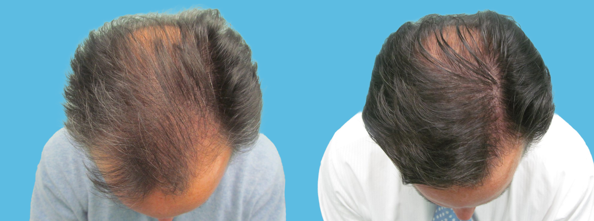 1 year robotic hair transplantation (1,400 grafts) 