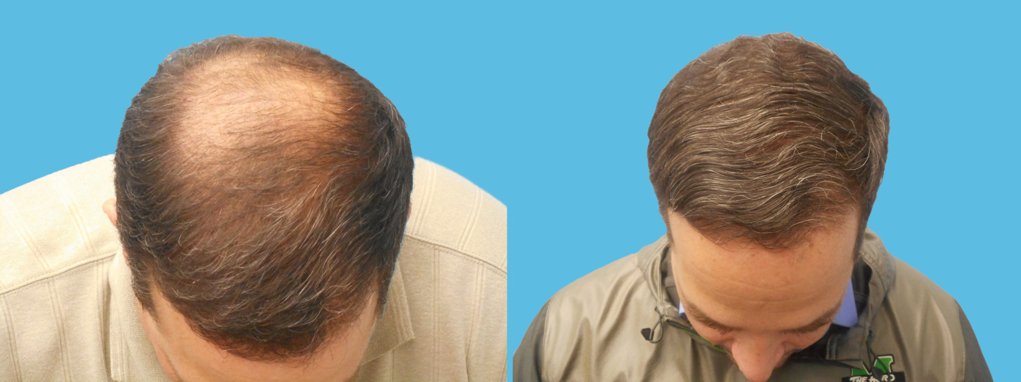 1 year robotic hair transplantation (2,244 grafts) 