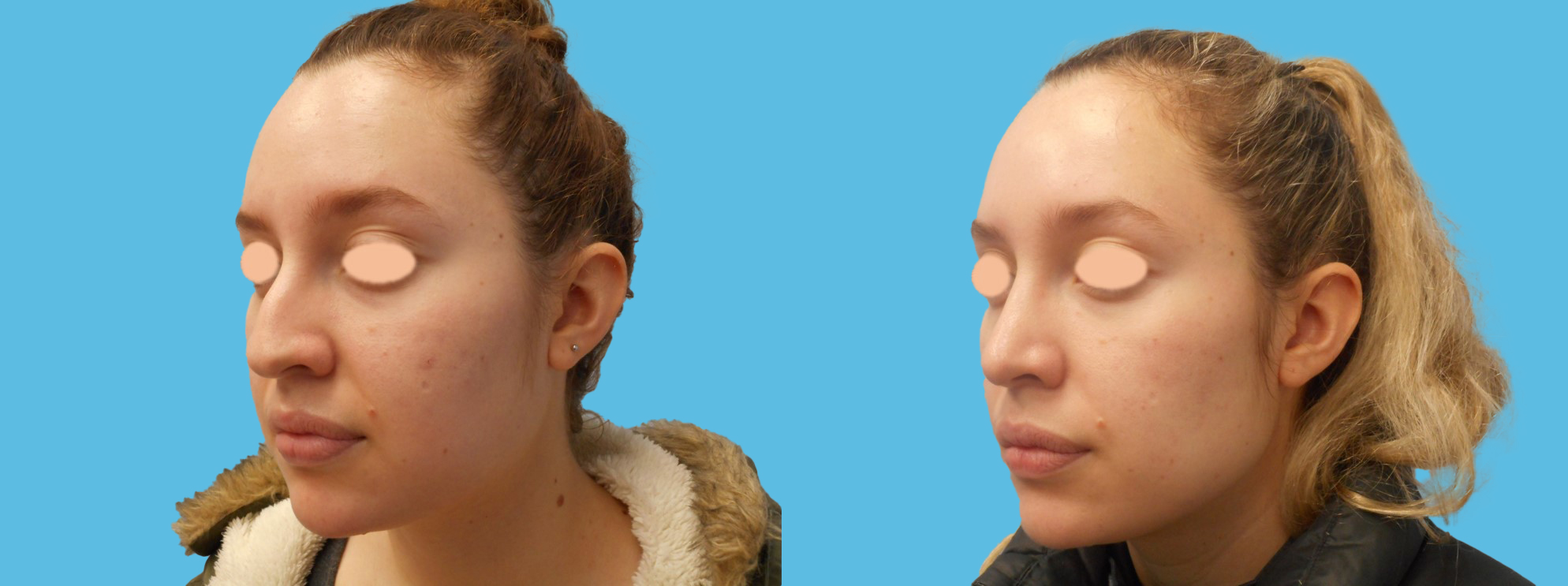 1 year rhinoplasty