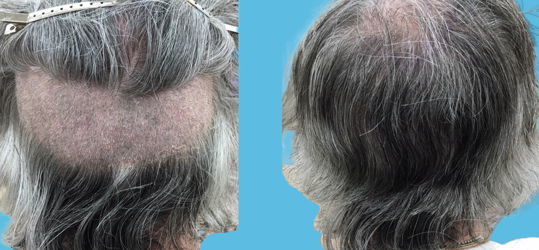 Robotic Hair Transplantation – Long Hair Shave Strategy