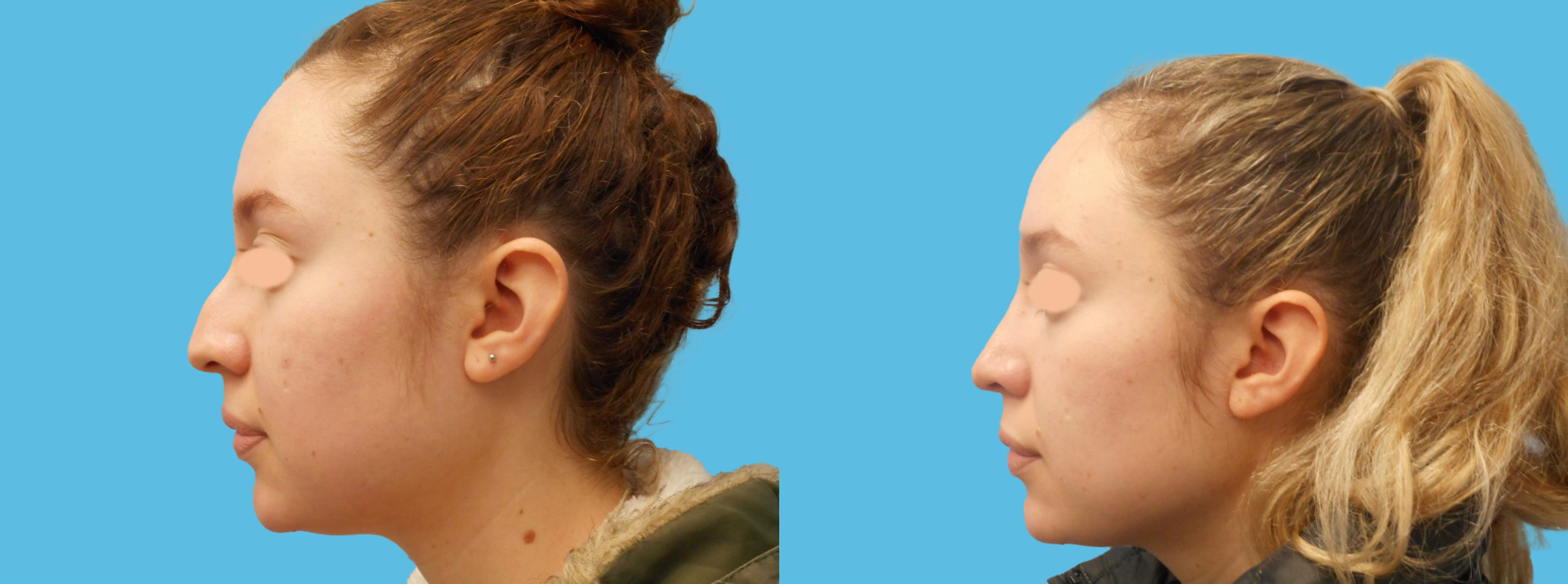 1 year rhinoplasty