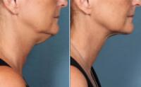 Kybella NJ