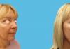 8 weeks facelift, necklift, upper blepharoplasty