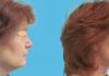 1 month facelift, necklift, lower eyelid and perioral CO2 laser